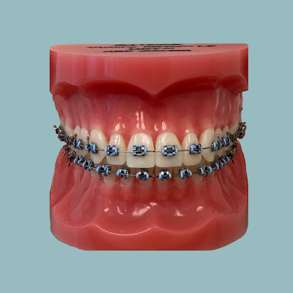 Braces Beaverton
